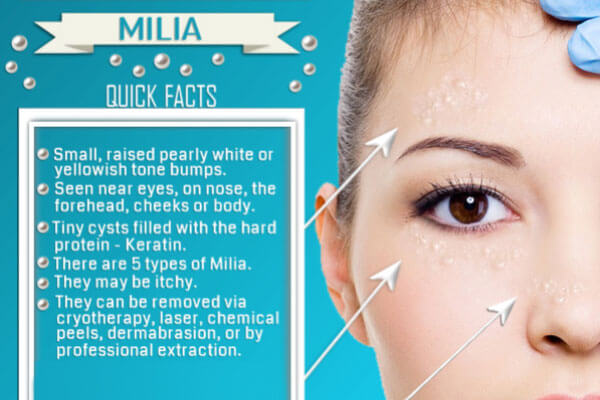 facts-about-milia