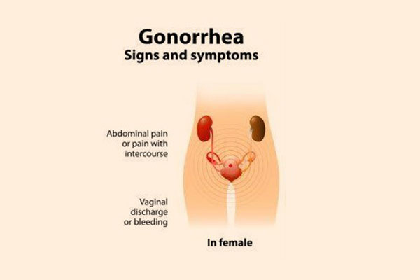 gonorrhea symptoms in women