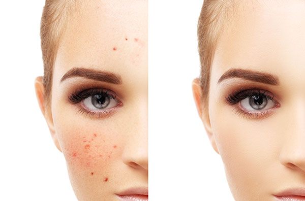 causes of hyperpigmentation from acne