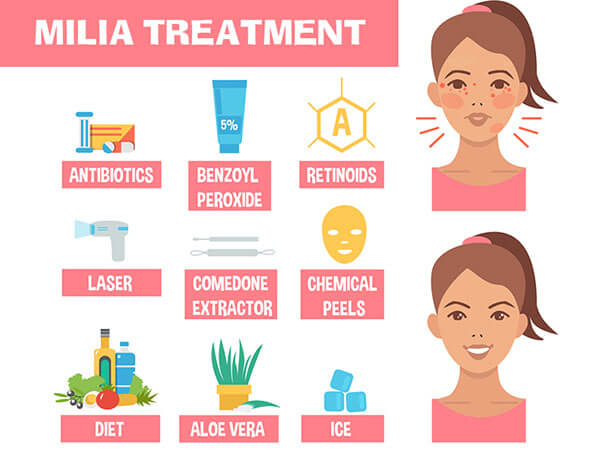 other-remedies-to-milia