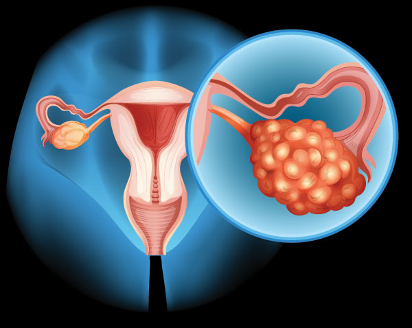 ovarian cancer diagram