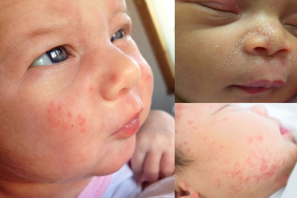 signs of baby acne