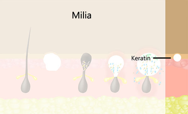 signs-of-milia