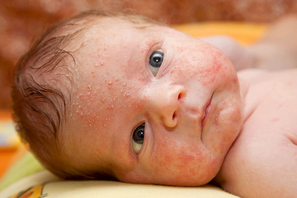what is baby acne