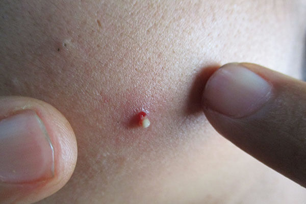 Popped pimple keeps filling with pus