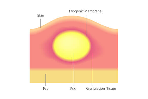 Clear Liquid Pimple: Reason Of Formation And How To Treat It