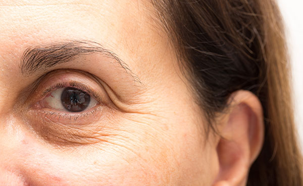 wrinkles around the eyes