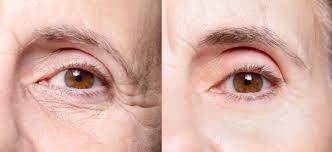Plexaderm Before and After Pictures