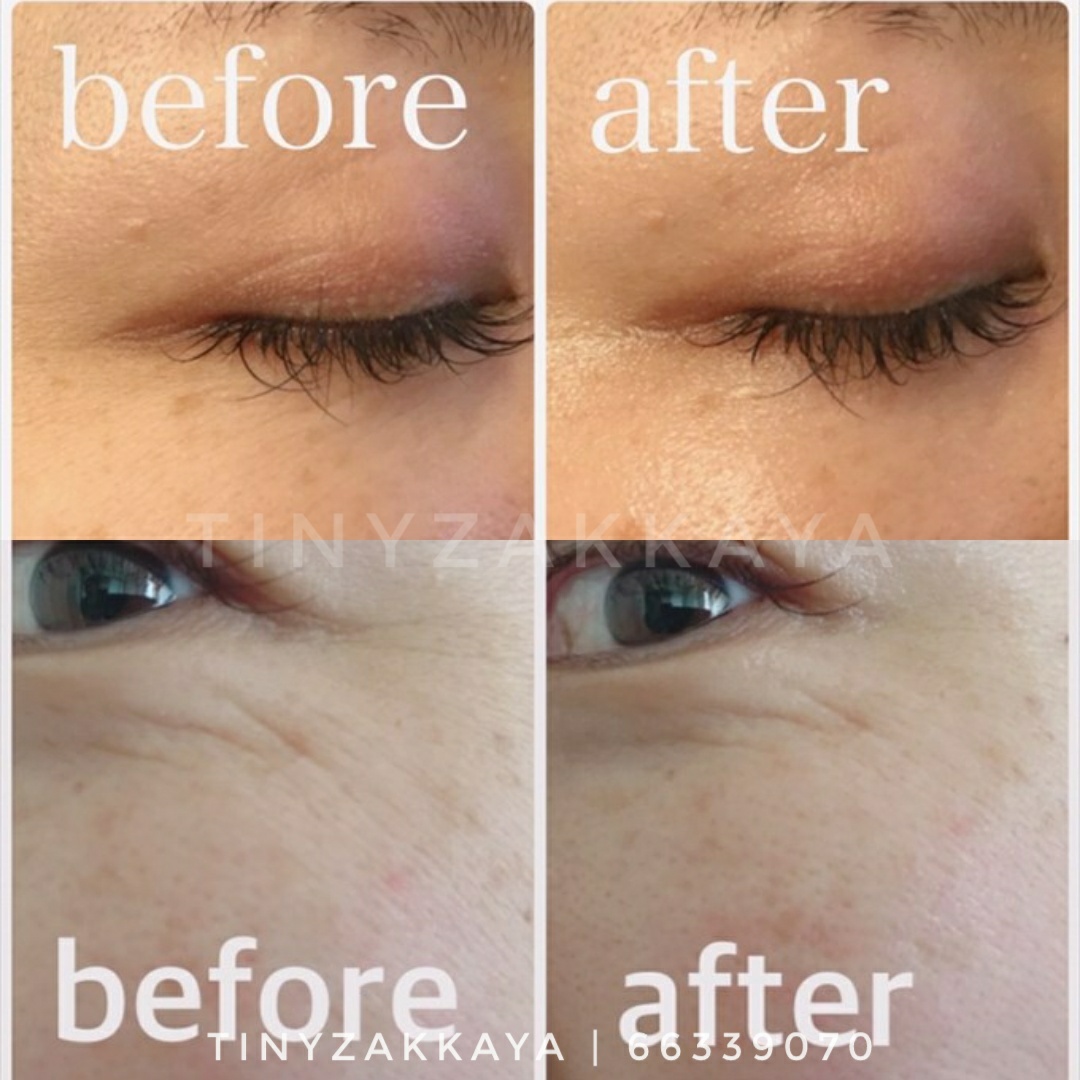 Attenir – Eye Extra Serum Review Before and After Pictures