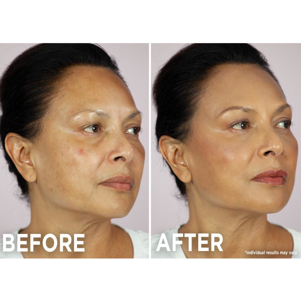 Plexaderm Before and After Pictures
