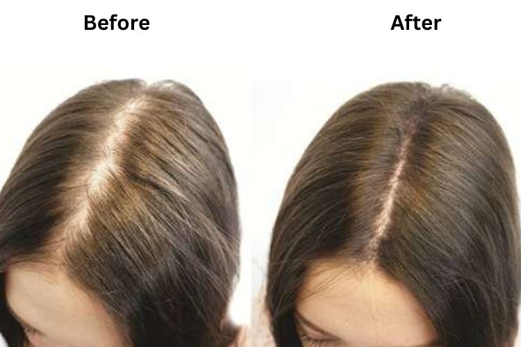 BioGlow hair growth gummies before and after