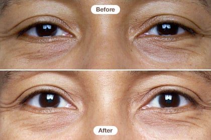Burt’s Bees Before and After Pictures