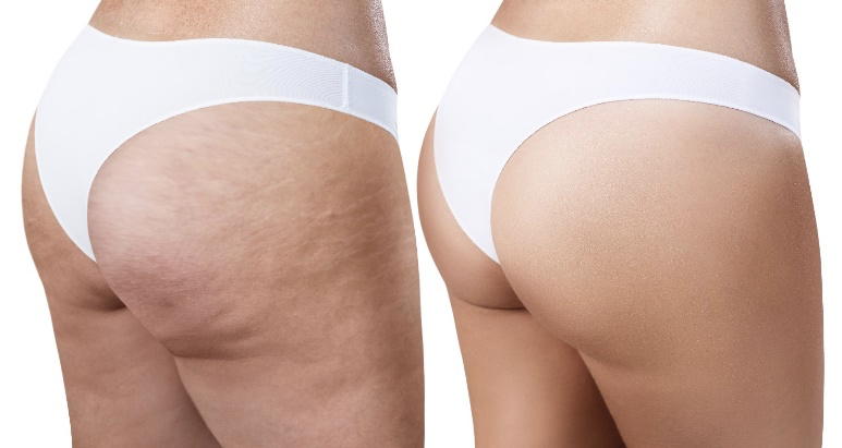 Sol De Janeiro Brazilian Bum Bum Body Cream For Cellulite Before and After