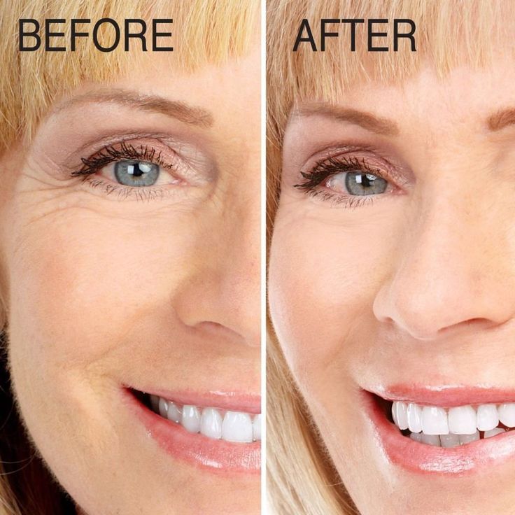 Dermalactives Eye Cream Review Should You Really Buy This Product?