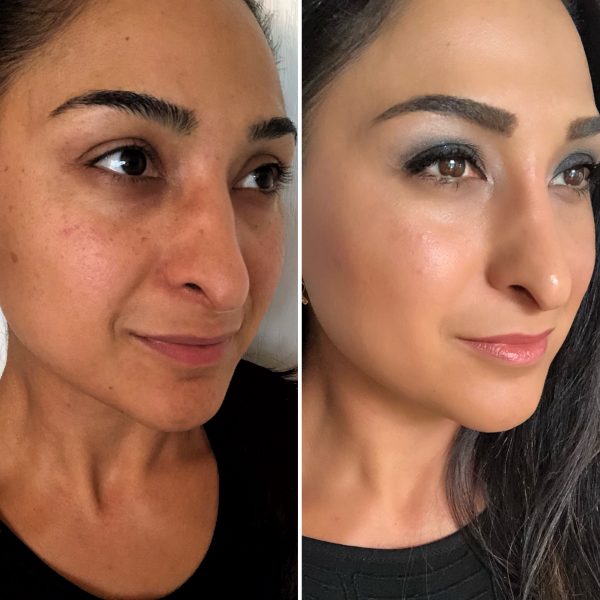 Plexaderm Before and After Pictures