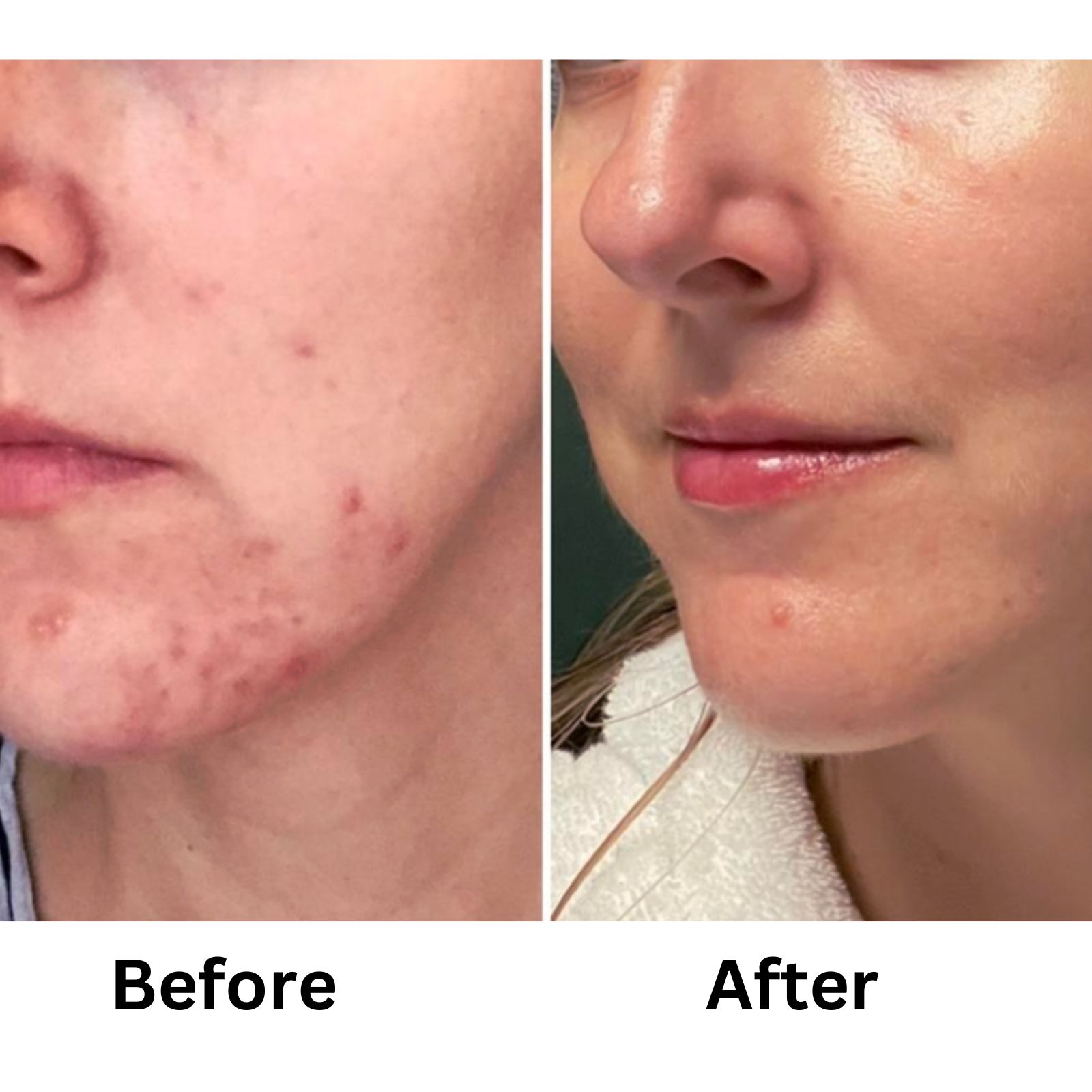 Illuderma before and after