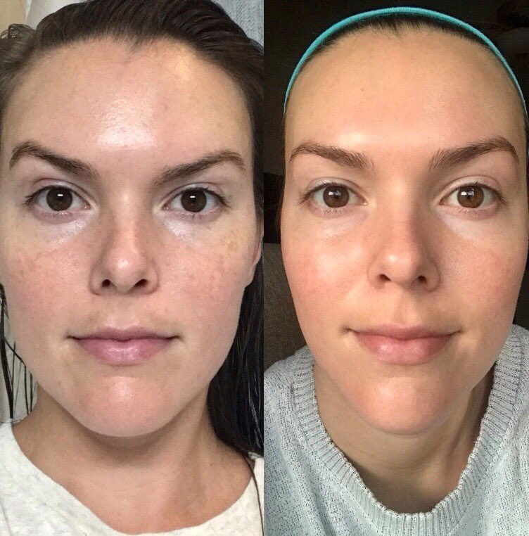 Jan Marini Bioglycolic Face Cleanser Before and After Pictures