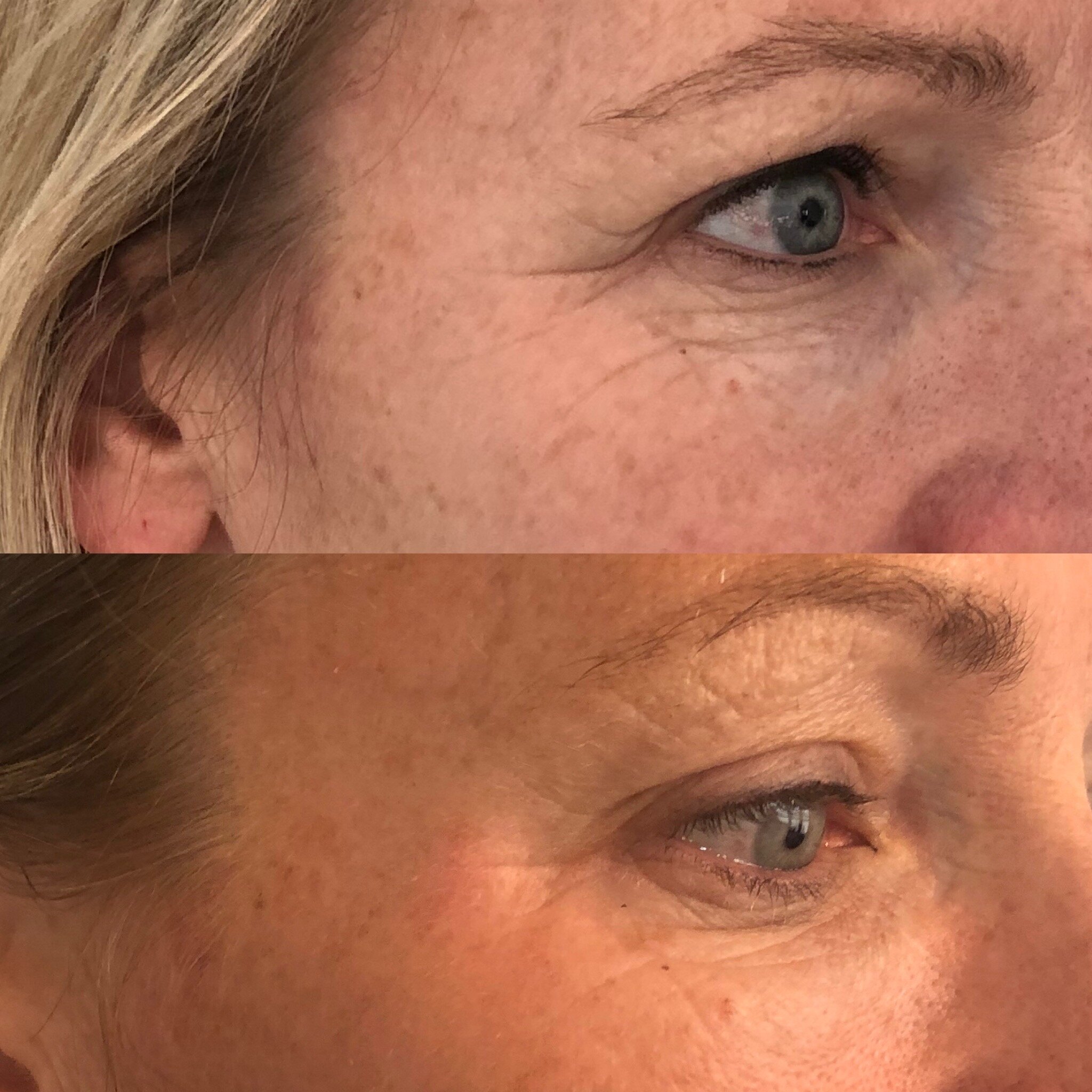 Obagi ELASTIderm Eye Complete Complex Serum Before and After Pictures