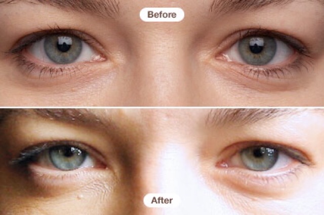 Olay Deep Hydrating Eye Gel Before and After Picture width=