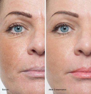 Serious Skincare Insta Tox Before and After Images