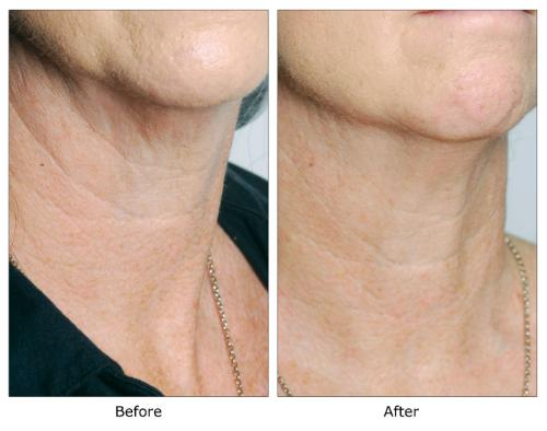 Shiseido Benefiance Concentrated Neck Contour Treatment before and after