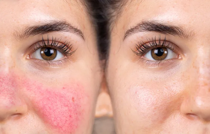 Skinception Rosacea Treatment Before and After Images Pictures