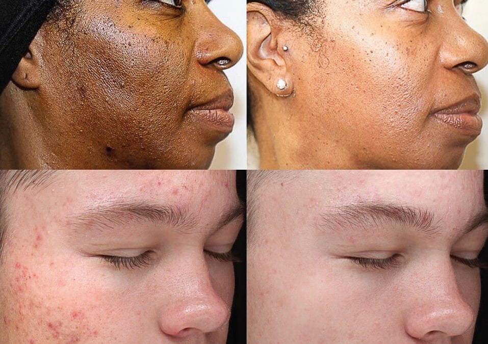 Skinceuticals Lha Cleansing Gel  Before and After Pictures