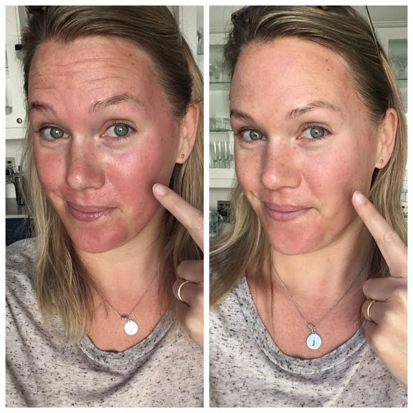 Skinceuticals Before and After Pictures