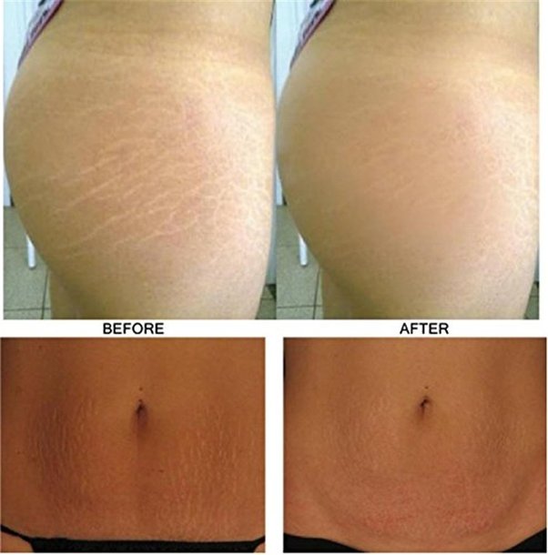 Talika Zero Stretch Mark Cream Pictures