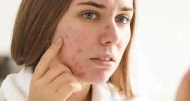 What Causes Cystic Acne? Its Symptoms And Treatment To Remove It