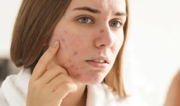 What Causes Cystic Acne? Its Symptoms And Treatment To Remove It