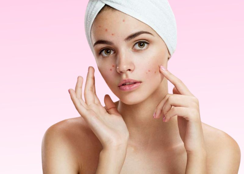 Best Acne Creams That Actually Work
