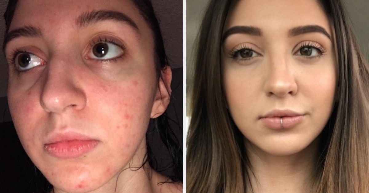 CeraVe Moisturizing Cream Before and After Pictures