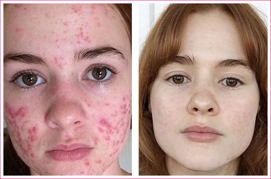 Clear Pores Acne Treatment Before and After Images