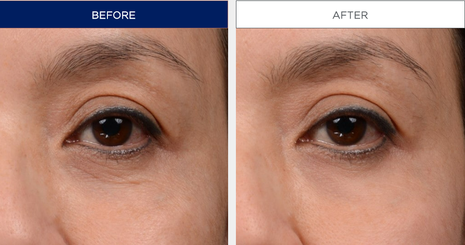 Clinique Pep-Start Eye Cream before and after images
