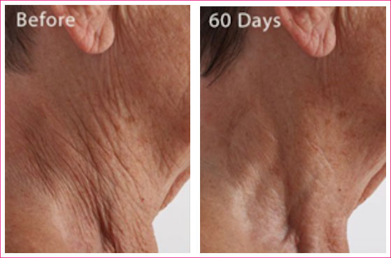 Crepe Erase before and after images