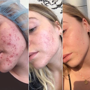 Dermalogica Before and After Image