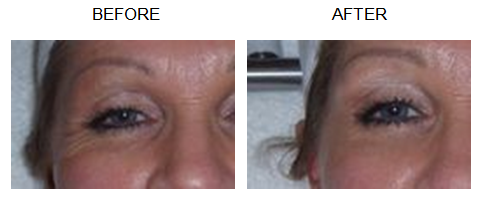 Plexaderm Before and After Pictures