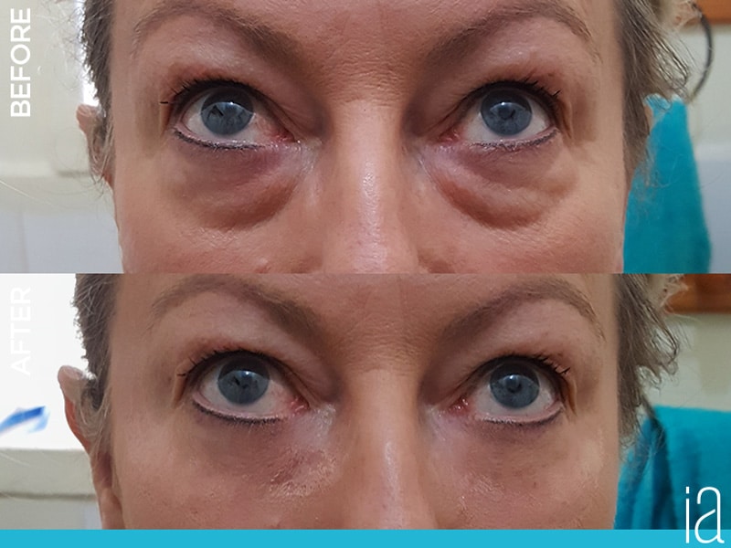 Instantly Ageless Before and After Image