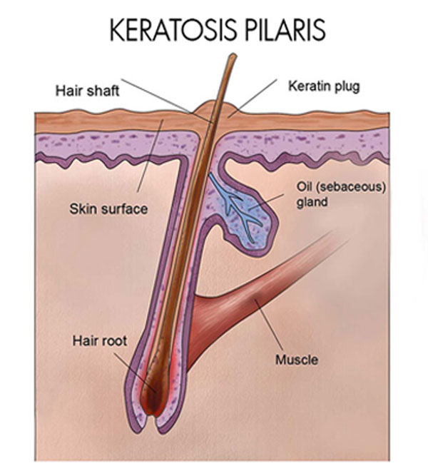 keratosis pilaris treatment
