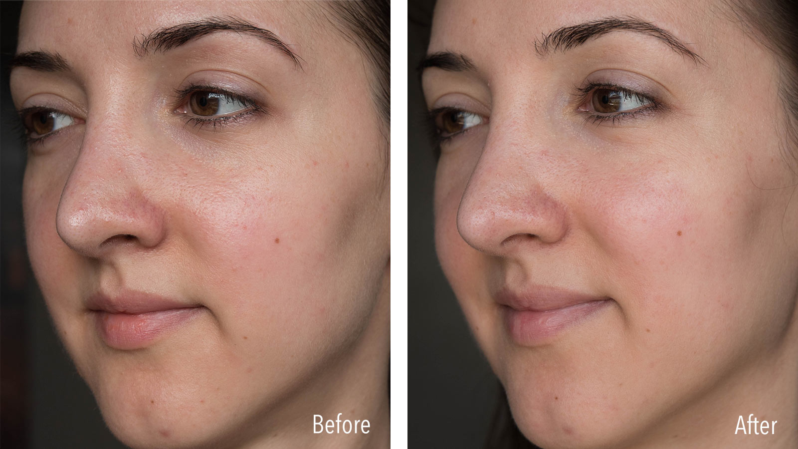 Plexaderm Before and After Pictures