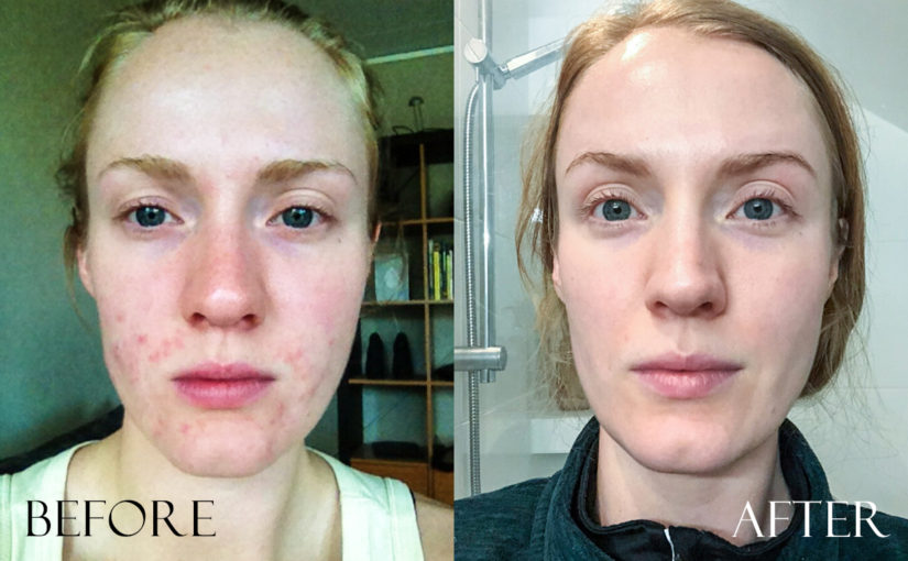 Peter Thomas Roth Before and After Pictures