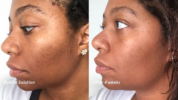 Plexaderm Before and After Pictures