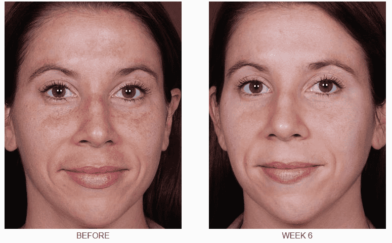 Skinceuticals Before and After Pictures